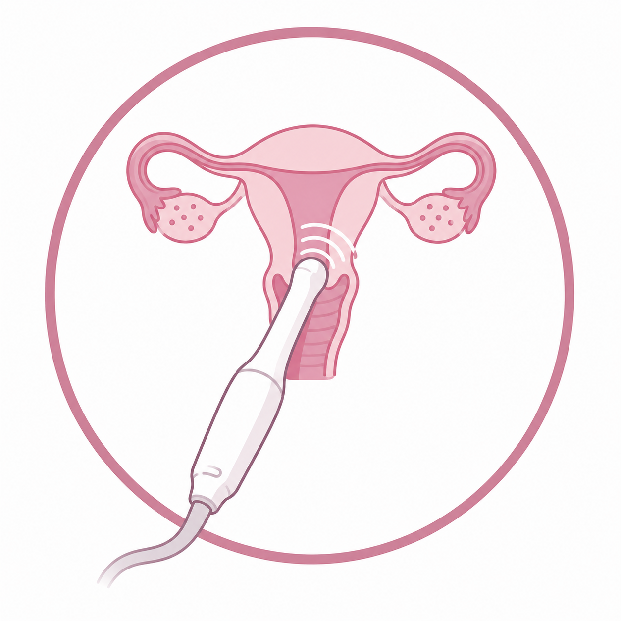 Ultrassonografia Transvaginal
